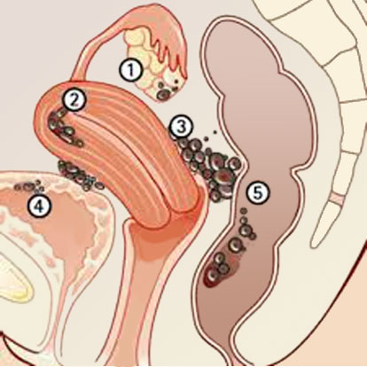 L'Endométriose - Gynecologie-obstetrique